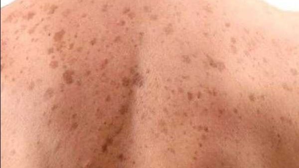 فطريات التينيا الجلدية