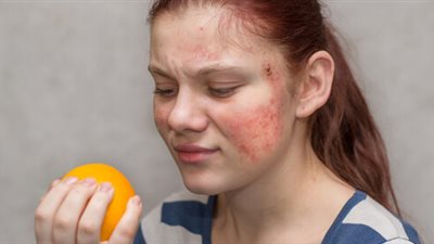 تعرف على أعراض حساسية الطعام وأبرز الأطعمة المسببة للإصابة