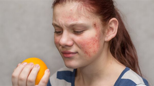 حساسية الطعام 