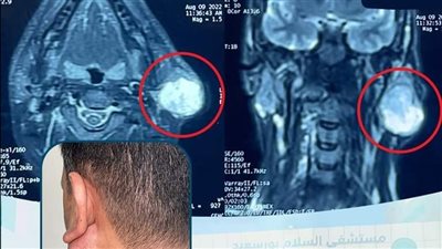 أصعب أنواع الجراحات.. استئصال ورم خطير بالغدة النكافية بالتأمين الصحي الشامل ببورسعيد