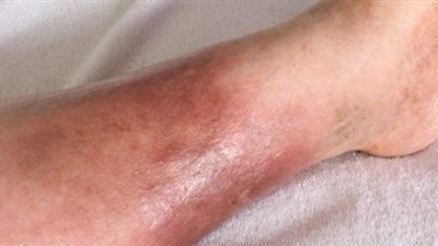 التهاب النسيج الخلوي العميق.. ظهور أعراض جديدة للإصابة بجدري القرود