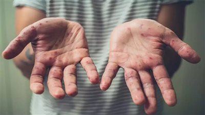 شيكاغو الأمريكية تسجل حالتي وفاة بفيروس جدري القرود