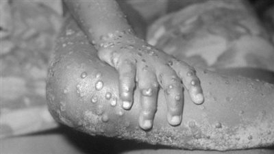 خطر الإصابة بـ فيروس جدري القرود أعلى لدى الأطفال أقل من 8 سنوات | دراسة