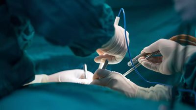 شملت 50 طبيبًا ومسعفًا.. سيدة تستعيد بصرها بعد جراحة معقدة استغرقت يومين 