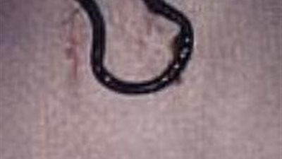 أطباء يكتشفون حلقة أنف لرجل في رئته بعد فقدانها قبل 5 سنوات | صور 