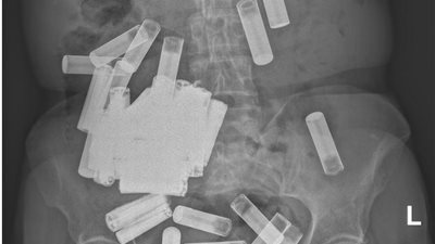 الأولى من نوعها.. أطباء يعثرون على 55 بطارية في جسد امرأة 