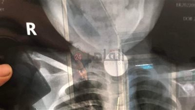 إنقاذ حياة طفل بعد ابتلاعه جنيها معدنيا في المنوفية