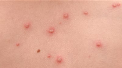 ارتفاع معدل الإصابة بجدري الماء في الهند