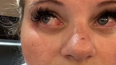 من الفرح للمستشفى.. الرموش الصناعية تهدد عروسًا بالعمى │ صور 