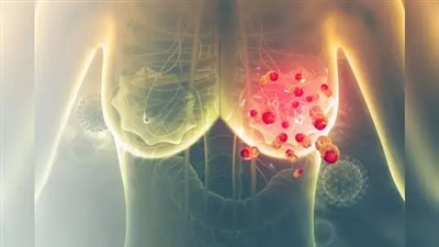 النساء السود أكثر عرضة للوفاة بسرطان الثدي بنسبة 40% مقارنة بالبيض | دراسة