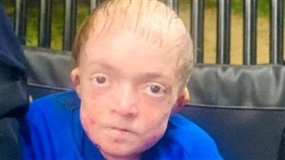 وفاة الشاب محمد سامي مريض تآكل العظام بالمنوفية بعد صراع مع المرض