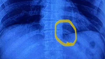 فريق طبي ينجح في استخراج إبرة تنجيد استقرت بصدر مريض منذ عامين بـ القليوبية | بث مباشر 