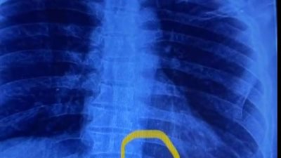 استقرت في جسده عامين.. فريق طبي من مستشفى بنها الجامعي يستخرج إبرة تنجيد من ظهر مريض|فيديو