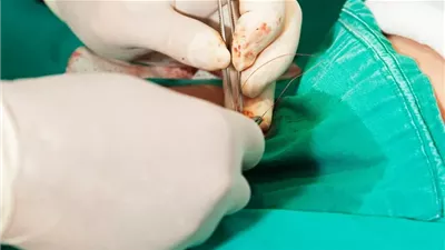 أب يتهم طبيبا ببتر جزء من العضو الذكري لنجله خلال عملية ختان في قنا