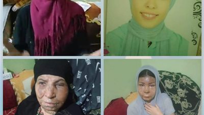 والدة ضحية إلقاء مياه نار على وجهها بقليوب: والد المتهم قال لنا يا ريت الرفض يكون منكم