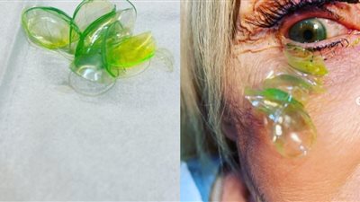 لم أر شيئًا كهذا من قبل.. طبيبة تزيل 23 عدسة لاصقة من عين مريضة | فيديو 