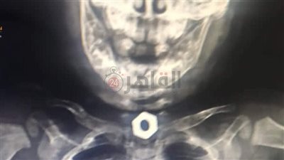 فريق طبي ينجح في استخراج جسم معدني من معدة رضيع عمره 8 أشهر بالغردقة| صور