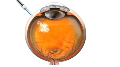 التأمين الصحي الشامل: نجاح إجراء حقن بالجسم الزجاجي لعيني طفلة مبتسرة في بورسعيد