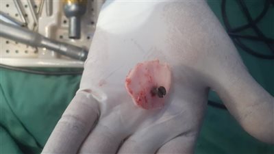 استخراج مسمار اخترق عظام جمجمة طفل بمستشفى أسوان الجامعي 