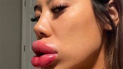 حقن بوتكس يتسبب في انتفاخ شفاة فتاة كالبالون | ما القصة؟