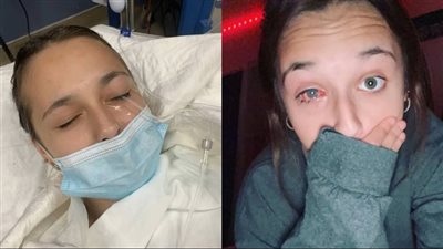 إصابة مراهقة بالعمى عقب انفجار أنبوب صبغة الشعر في وجهها