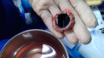 استغرقت كل منهما 6 ساعات.. أطباء بنها الجامعي ينجحون في إجراء جراحتي قلب وإنقاذ حياة طفلة وسيدة