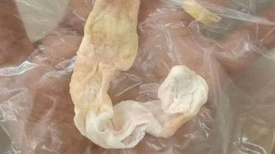 بلاغ يتهم مستشفى خاصا بالسويس بنسيان قطعة شاش طولها 30 سم في أنف طفلة