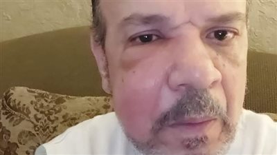 بعد ظهوره بوجه متورم.. أحمد سلامة يكشف عن طبيعة مرضه