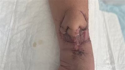 بعد أن دمرها سرطان الجيوب الأنفية.. جراحون يزرعون أنفًا على ذراع امرأة قبل نقله لوجهها 