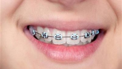 الإفتاء توضح حكم الشرع في تقويم الأسنان