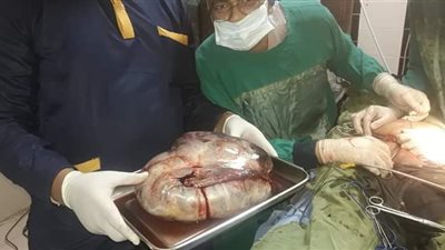 استئصال كيس يزن 12 كيلو من مبيض سيدة بمستشفى قوص في قنا (صور)