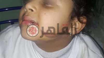 أم تعذب طفلتها وتحرقها بسكين في أماكن متفرقة بالجسم بسوهاج (صور وفيديو)