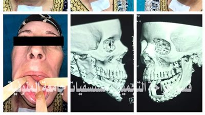 عملية نادرة.. جامعة المنوفية تنجح في إعادة بناء فك بعد استئصاله لوجود ورم خبيث