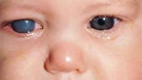الجولوكوما عند الأطفال