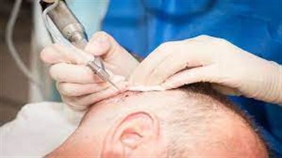 وفاة رجل بتعفن الدم بعد زراعة الشعر في الهند..ما مدى خطورة العملية ؟
