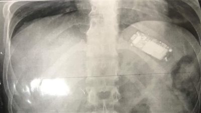 ابتلعه منذ شهرين.. استخراج تليفون محمول من بطن شاب بالمنصورة