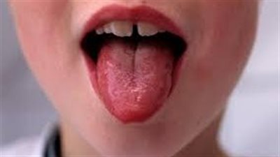  بعد وفاة 9 أطفال.. بريطانيا: تفشي العدوى البكتيرية العقدية بين الصغار