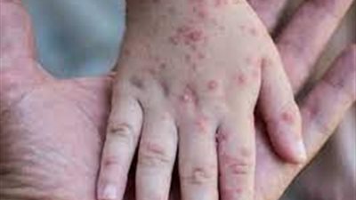 يضرب ولاية هندية جديدة.. تعرف على أبرز الحقائق عن جدري القرود 