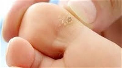 أبرزها شرائح الليمون.. 5 طرق منزلية للتخلص من عين السمكة