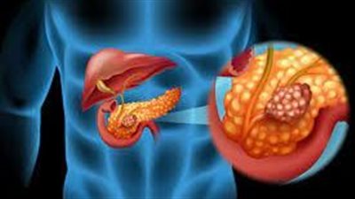 باحثون يحددون عادة يومية شائعة تسبب الإصابة بسرطان البنكرياس |دراسة 