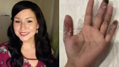 عملية تجميلية تتسبب في بتر أصابع سيدة بعد إصابتها بالعفن