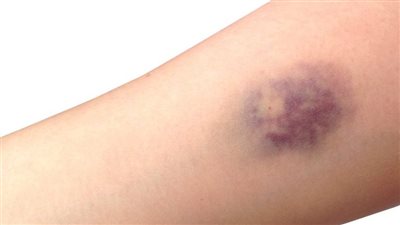 لون البشرة أبرز العلامات التي تشير لخطر الإصابة بالنوبات القلبية