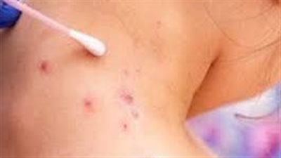 سهم شركة أدوية يقفز 48% بعد تطوير لقاح لجدري القرود