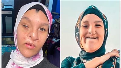 اليوتيوبر إسراء أحمد تنشر أول صورة لها بعد إجراء عملية تجميلية.. معلقة: بصوا عاوزاكم تنبهروا
