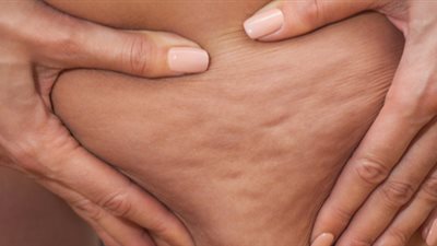 دراسة: السيلوليت عند النساء يحمي من الخرف والسكتات الدماغية 