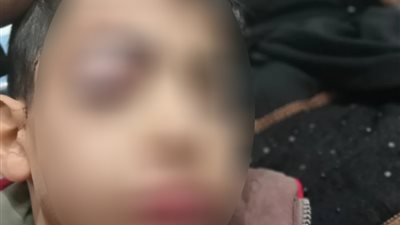 كان راجع من مدرسته.. تفاصيل فقدان طالب إحدى عينيه وإصابة ممرضة بخرطوش بالقليوبية