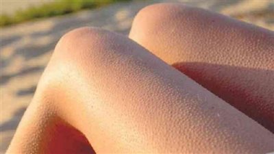 أبرزها الترطيب.. 5 طرق للوقاية من التقرن الجلدي خلال فصل الشتاء