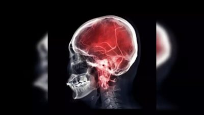 ما هو مرض الاعتلال الكبدي وأعراضه وطرق الوقاية منه؟