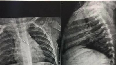بنها الجامعي ينقذ حياة طفل عمره عاما ابتلع دبوس طرحة 