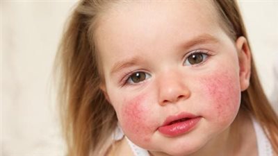 احمرار الوجه وضيق التنفس.. أبرز أعراض الإصابة بحساسية السمسم 